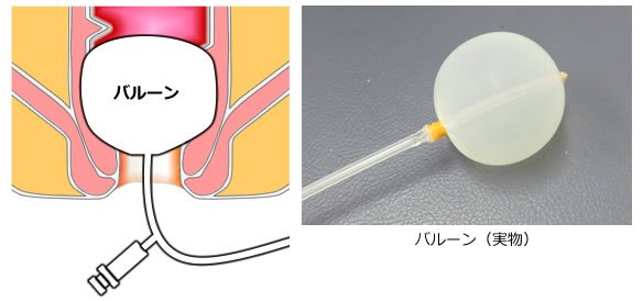 直腸鏡検査と S 状結腸鏡検査