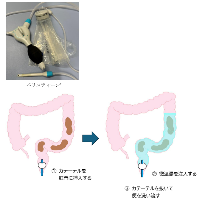 腸管洗浄イメージ.png
