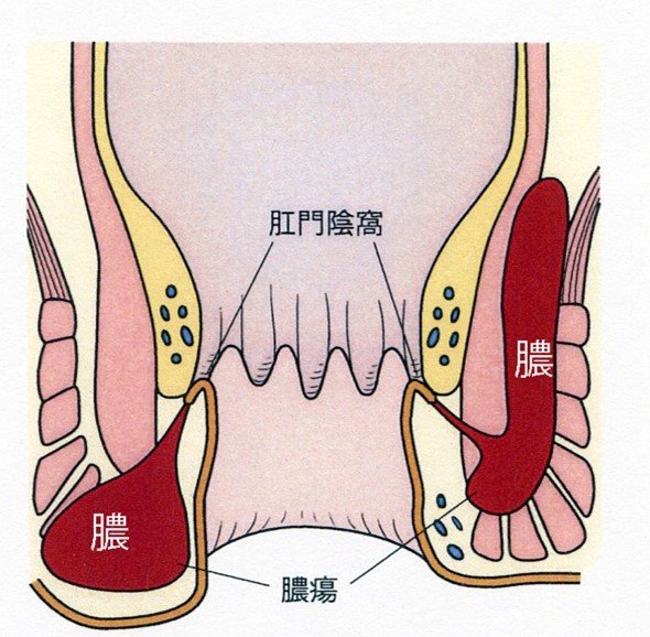 膿瘍.jpg