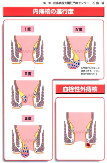 内痔核.png