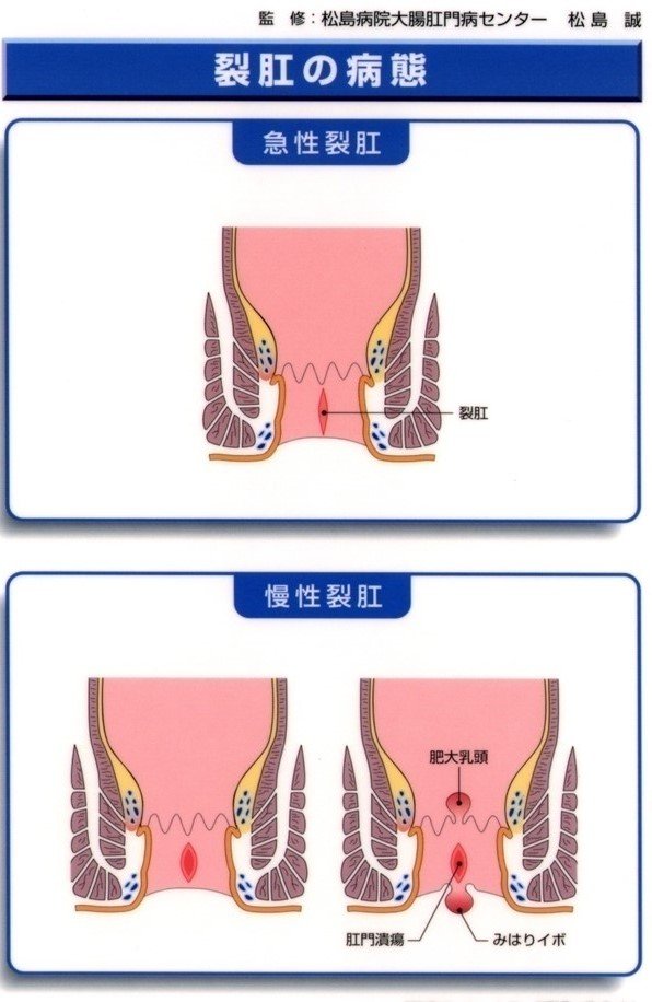 裂肛2.jpg
